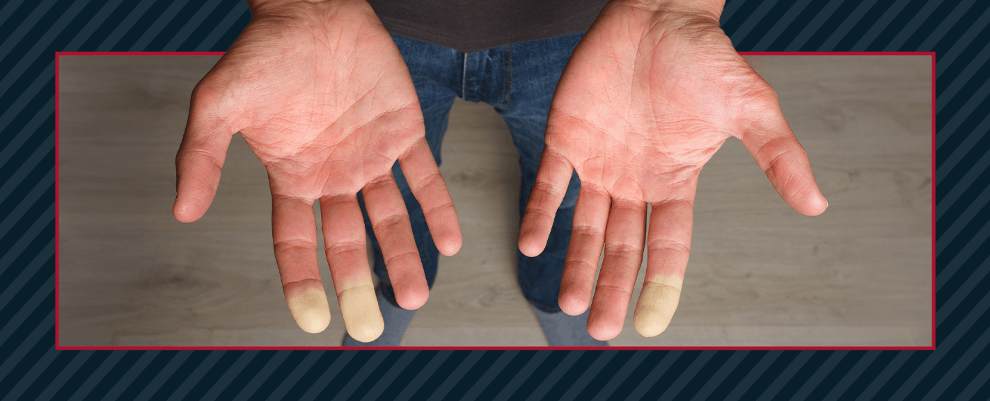 Hand-Arm Vibration Syndrome